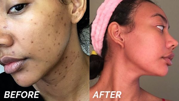 Dark Spot Remover - MIRACLE in a Bottle - Hyperpigmentation Fix Fashion - Image 5